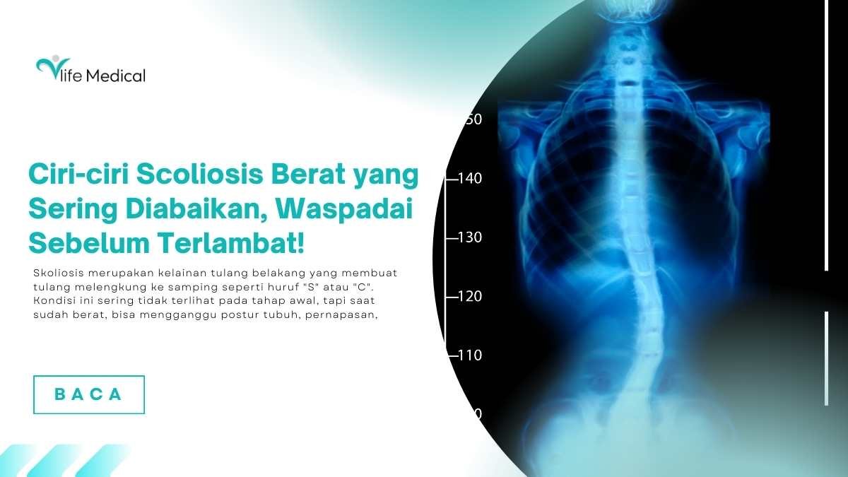 Ciri-ciri-Scoliosis-Berat-yang-Sering-Diabaikan-Waspadai-Sebelum-Terlambat.jpg