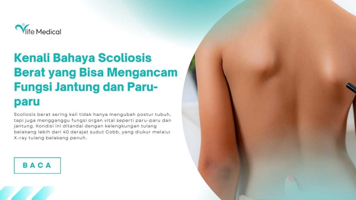 Kenali-Bahaya-Scoliosis-Berat-yang-Bisa-Mengancam-Fungsi-Jantung-dan-Paru-paru.jpg